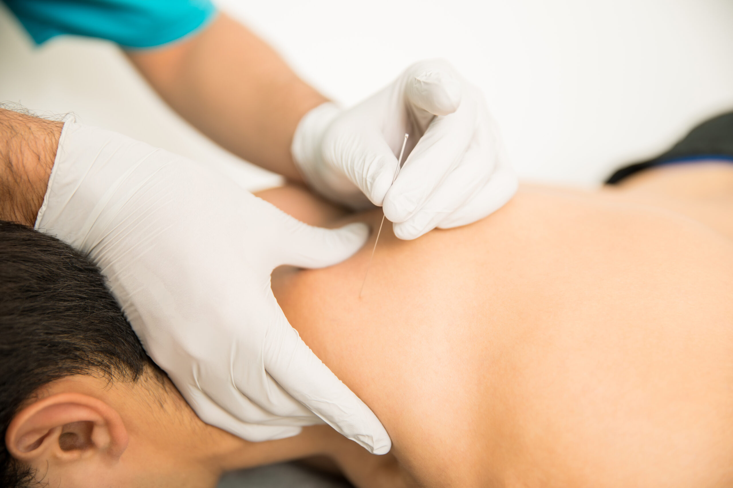 Patient Receiving Targeted Dry Needling for Muscle Spasm Release in Auckland