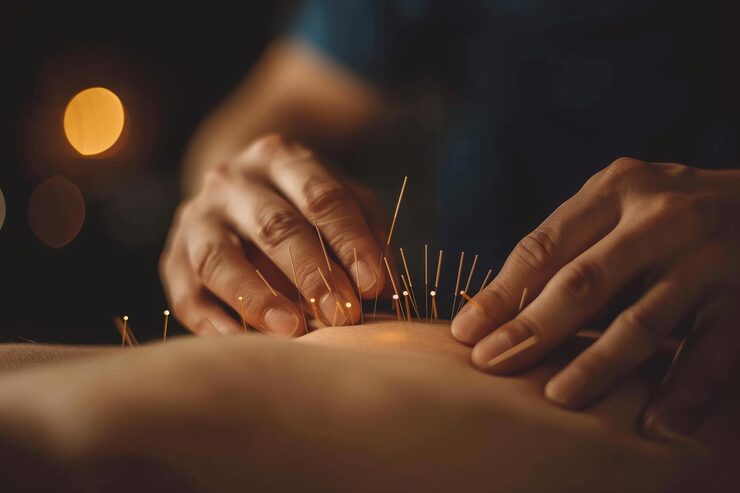 Acupuncture Needle Treatment and Back Pain Relief at Pinehill Physio